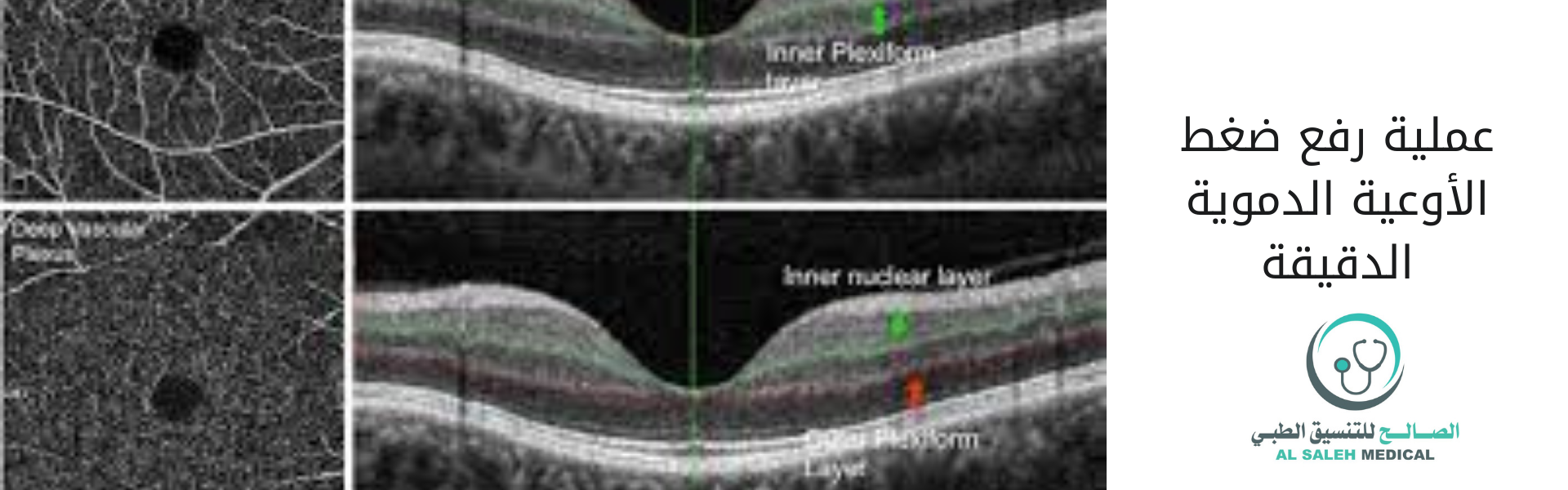 عملية رفع ضغط الأوعية الدموية الدقيقة| العوامل والاسباب والتكاليف